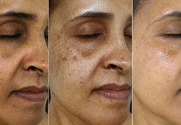 Why Do Dark Spots Get Darker Before They Get Lighter?