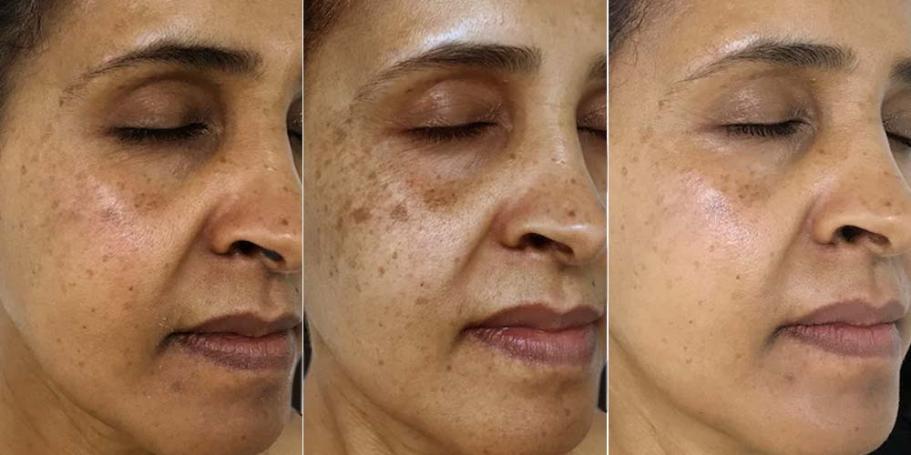 Why Do Dark Spots Get Darker Before They Get Lighter? Vivant Skin Care Why Do Dark Spots Get Darker Before They Get Lighter? Vivant Skin Care