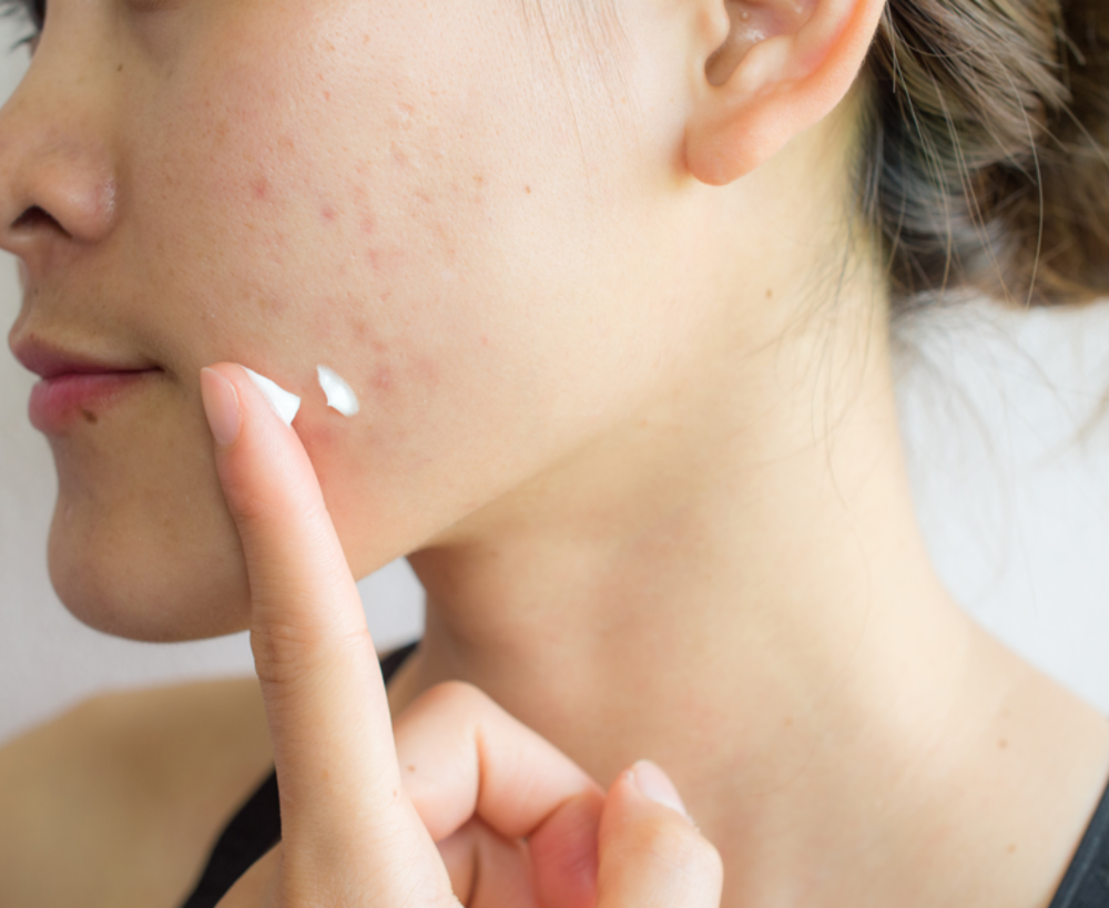 Are Acne Scars Reversible?
