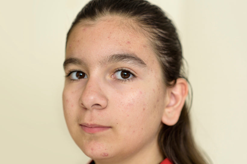 How to Preempt Preteen Acne