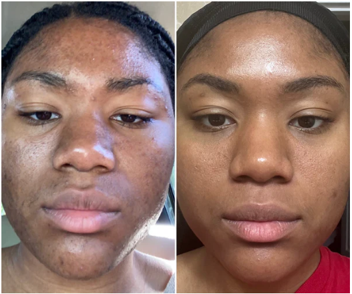 Before and After Using Mandelic Acid for Dark Spot Repair