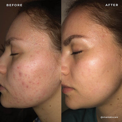 BP 3% Acne Treatment Wash