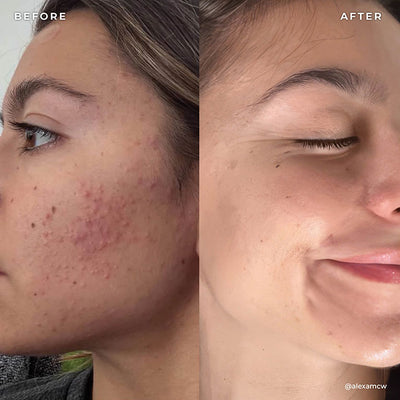 BP 3% Acne Treatment Wash
