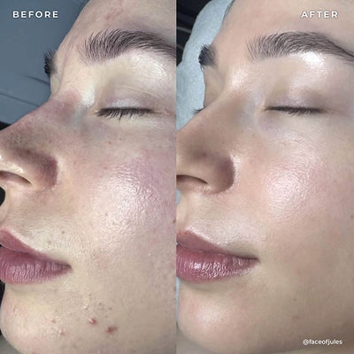 BP 3% Acne Treatment Wash