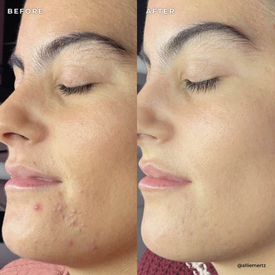 BP 3% Acne Treatment Wash