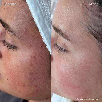 BP 3% Acne Treatment Wash