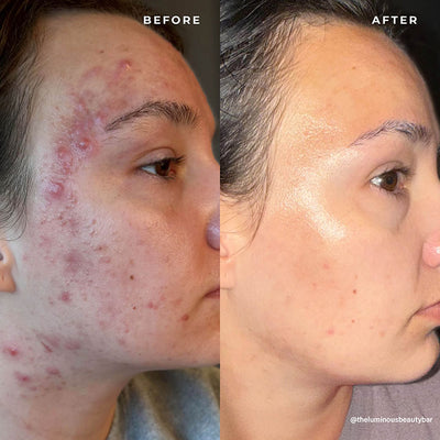 BP 3% Acne Treatment Wash