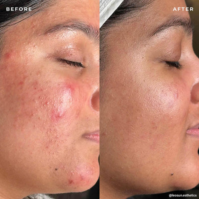 BP 3% Acne Treatment Wash