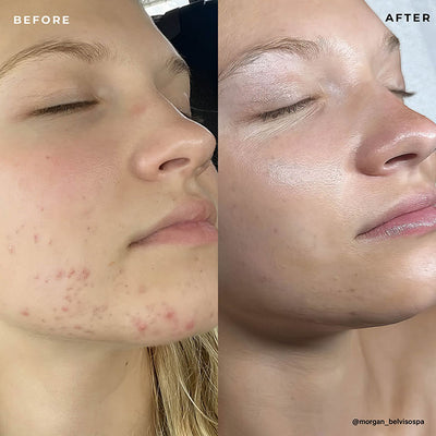 BP 3% Acne Treatment Wash