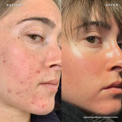 BP 3% Acne Treatment Wash