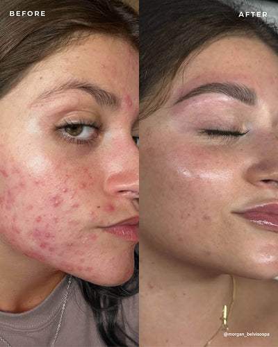 BP 3% Acne Treatment Wash
