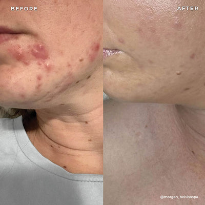BP 3% Acne Treatment Wash
