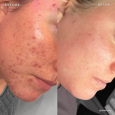 BP 3% Acne Treatment Wash