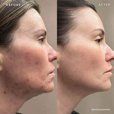 BP 3% Acne Treatment Wash