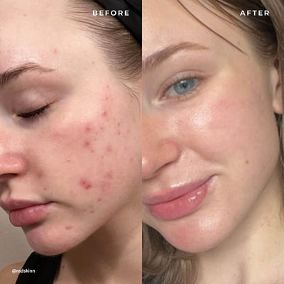 BP 3% Acne Treatment Wash