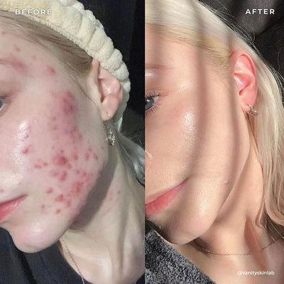 BP 3% Acne Treatment Wash