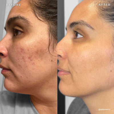 BP 3% Acne Treatment Wash