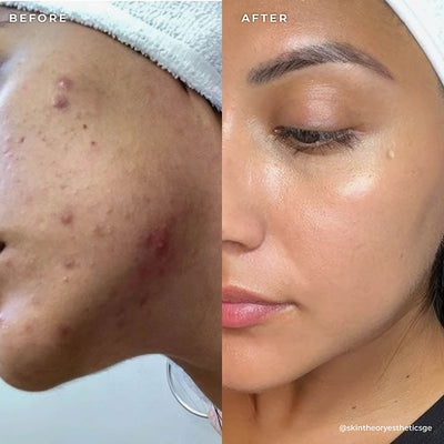 BP 3% Acne Treatment Wash
