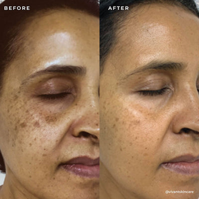 BP 3% Acne Treatment Wash