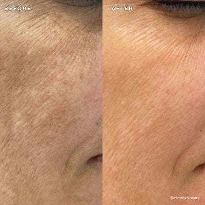 BP 3% Acne Treatment Wash