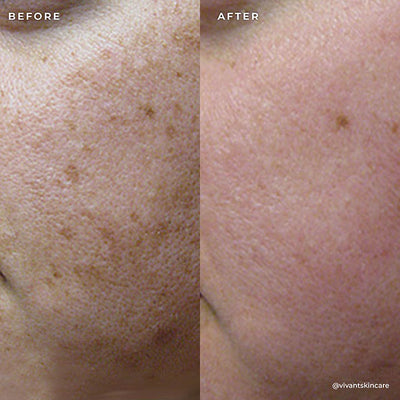 BP 3% Acne Treatment Wash