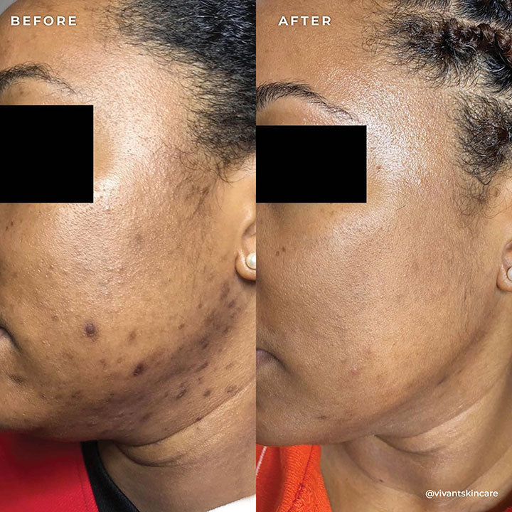 FF3 Manuka Enzyme Lift – Vivant Skin Care®
