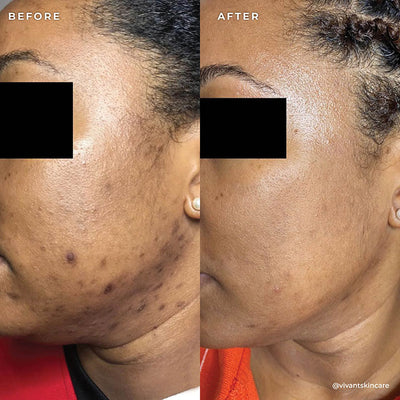 BP 3% Acne Treatment Wash
