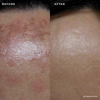 BP 3% Acne Treatment Wash