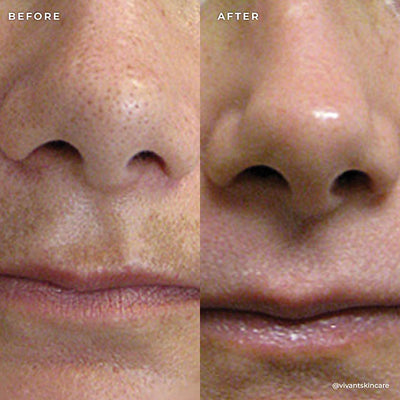 BP 3% Acne Treatment Wash