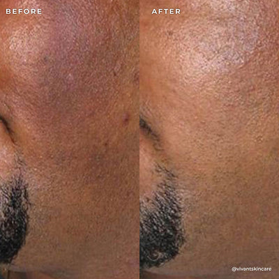 BP 3% Acne Treatment Wash