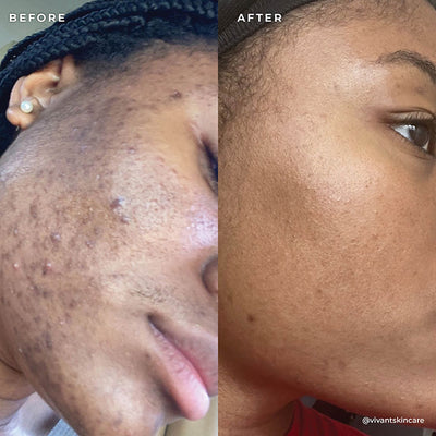 BP 3% Acne Treatment Wash