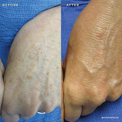 BP 3% Acne Treatment Wash