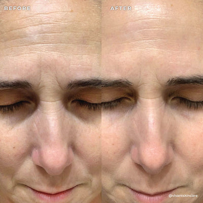 BP 3% Acne Treatment Wash