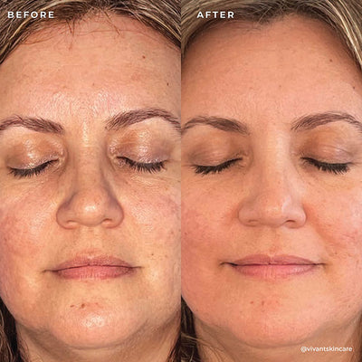 BP 3% Acne Treatment Wash