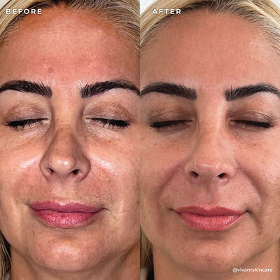 BP 3% Acne Treatment Wash