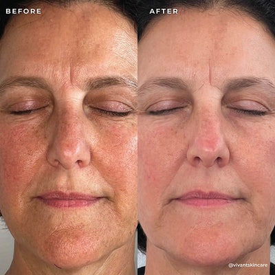 BP 3% Acne Treatment Wash
