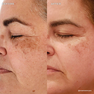 BP 3% Acne Treatment Wash