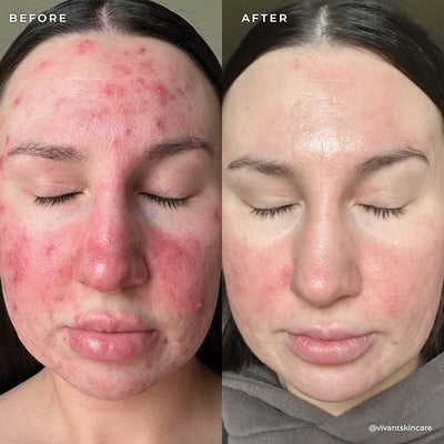 BP 3% Acne Treatment Wash