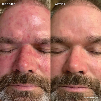 BP 3% Acne Treatment Wash