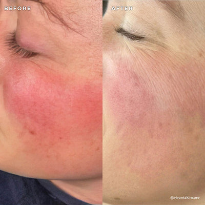 BP 3% Acne Treatment Wash