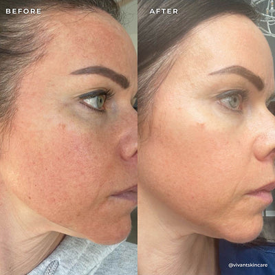 BP 3% Acne Treatment Wash