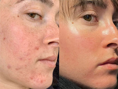 ACNE-PRONE SKIN