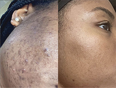 UNEVEN TONE & DARK SPOTS