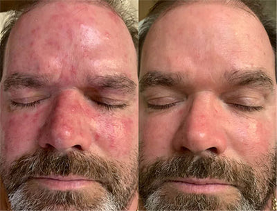 SENSITIVE SKIN